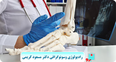 تأثیر وراثت بر پوکی استخوان در سنین زیر ۴۰ سال